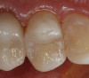 Figure 18  ENDODONTIC AND ESTHETIC PARAMETERS  The restoration in place shows asymmetry in the papilla of teeth Nos. 8 through 10. Soft-tissue changes should always be considered when extraction is proposed.