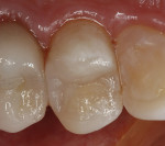 Figure 7  An occlusal view of the completed restoration.