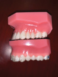 Fig 11. The trimline on ClearCorrect aligners (top) is higher than on other aligners that use a scalloped trimline near the cementoenamel junction (bottom). This characteristic helps make the ClearCorrect aligners highly retentive and enable a more efficient treament outcome.