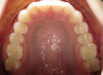 Fig 2. Occlusal view of maxillary arch before treatment.