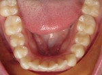 Fig 3. Occlusal view of mandibular arch before treatment.