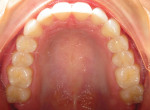Fig 8. Occlusal view of maxillary arch after 5 months of treatment.