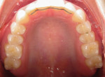 Fig 14. Occlusal view of maxillary arch after
treatment.
