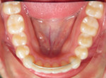 Fig 15. Occlusal view of mandibular arch after
treatment.