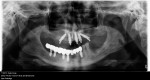 Fig 1. Postoperative panoramic radiograph. Note fractured implant in the apical region.