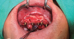 Fig 2. Surgical photograph. Nobel Biocare TiUltra NobelActive implants were placed using All-on-4 treatment concept. Xeal Multi-unit Abutments, which help foster soft-tissue health, were placed as well.