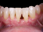 Fig 4. Post-extraction of tooth No. 24 and post-orthodontics. Upon completion of orthodontics a large residual black triangle, Miller Class III defect, remained between Nos. 23 and 25.