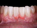 Fig 10. Final treatment outcome showing Shofu’s Beautifil II Gingiva. The patient was thrilled with the treatment outcome.