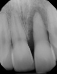 Fig 1. Periapical x-ray of tooth No. 9 showing radiolucency around the apex and extrusion of the tooth.
