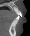 Fig 4. CBCT showing sagittal view of tooth No. 9 with periapical radiolucency and intact buccal plate.