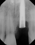 Fig 6. Periapical x-ray after placement of implant No. 9 before bone grafting.