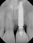 Fig 9. Periapical x-ray of implant No. 9 after bone graft and delivery of same-day provisional crown.