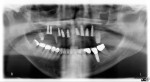 Figure 2  Panoramic X-ray showing placement of implants after extraction of teeth Nos. 4, 6, 7, 8, 10, 11, 12, 13, and 14. Teeth Nos. 2, 5, 9, and 14 were used to support the provisional.