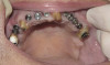 Figure  5  TECHNIQUE Occlusal view after the mesial‚Äìbuccal cusp has been removed. Remaining filling material will be removed at later steps.