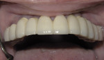 Figure 6  Clinical view of the maxillary PFM cemented bridge.