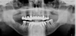 Figure 7  Radiographic view as the patient presented with a long-span fixed bridge supported by five teeth.