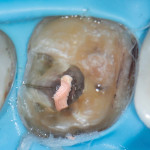 Crack propagation under a porcelainfused-to-metal crown that resulted in the need for root canal treatment and a guarded future prognosis.