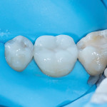 Posttreatment image of a mandibular first molar restored with a nonretentive ceramic overlay.