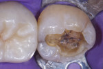 Removal of the amalgam revealed a fracture undermining the mesiolingual cusp that is connected to the peripheral rim fracture. Note the thin veil of occlusal enamel still present.