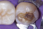 Progressive removal of the mesiolingual cusp exposed the presence of dehydrated dentin structurally disconnected from the pulpal floor.