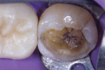 Once the dehydrated dentin was completely removed, a stained crack could be visualized, which was a continuation of the peripheral rim fracture where microleakage had begun.