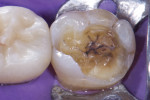Lingual view of the remaining mesiolingual cusp exhibiting intact enamel.