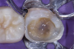 The dentin was coated with approximately 0.5 mm of resin (CLEARFIL MAJESTY™ Flow, Kuraray Noritake), then a peripheral composite shell was created incrementally (Filtek™ Supreme Ultra Universal Restorative [shade A2B], 3M™) (Filtek™ Supreme Ultra Flowable Restorative [shade A2B], 3M™).