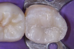 The dentin was replaced by incrementally layering composite (CLEARFIL™ AP-X, Kuraray Noritake), and then the enamel was replaced (Filtek™ Supreme Ultra Universal Restorative [shade A2B], 3M™).