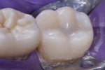 The final restoration was shaped and polished with carbide burs and composite polishers (H48LQ.FG.012, H379Q.FG.018, and 9525UF.RA.085; Komet USA). The primary anatomy provides function, while the smooth surfaces reduce biofilm accumulation.