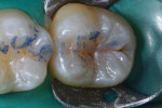 Pretreatment view of a molar with untreated occlusal caries.