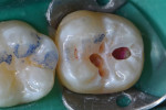 A caries disclosing agent (Caries Detector, Kuraray Noritake) was applied, then all caries was removed at the dentinoenamel junction. Intermittent access preserves occlusal tooth structure.