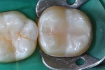 Remaining dentin replacement (CLEARFIL™ AP-X, Kuraray Noritake) and enamel replacement (Filtek™ Supreme Ultra Universal Restorative [shade A2B], 3M™) were then performed to compete the restoration.