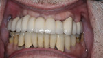 Figure 11  Clinical view of the PFM restorations.
