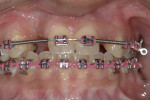 Figure 1  A 22-year-old woman presented halfway through orthodontic therapy. Note the mid-line deficiency, severe ridge defect in site No. 7, and asymmetrical spaces of edentulous sites Nos. 7 and 10; tooth No. 6 had been impacted and surgically remo