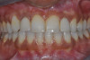 Figure 18  The mesial‚Äìbuccal cusp was removed with a horizontal cut that connected the mesial and buccal depth cuts.