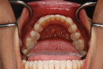 Posttreatment image following SureSmile clear aligner therapy.