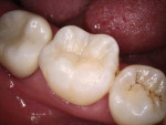 Posttreatment photograph demonstrating the excellent shade matching and esthetics achieved with OMNICHROMA BLOCKER FLOW and OMNICHROMA FLOW.