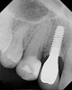 Figure 20  The remaining cusps on the lingual side were removed in a similar fashion. Then the remaining filling material and caries were removed.