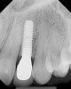 Figure 21   A #7801 finishing carbide bur was used to break the mesial contact. This cut provides a straight interproximal line aiding in tracing the digital margin on a monitor or in the laboratory.