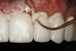 Figure 6  Vitalization began by staining the restorations according to a pre-determined colorization scheme that was rendered in a drawing prior to placement.