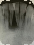 Pretreatment radiograph showing localized severe bone loss in the lower anterior region.