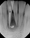 Radiograph following endodontic treatment of the nonvital pulp in tooth No. 25 showing severe bone loss and that the endodontic sealing material has extended beyond the apex.