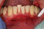 Surgical photograph showing the extent of the surgical field to treat the fistula, shallow vestibule, and lack of attached and keratinized gingiva.