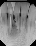 Radiograph of the area following removal of the excess sealer and periodontal regenerative treatment.
