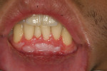 One-year posttreatment photograph and radiograph demonstrating significant improvement. The gingival grafting corrected for the shallow vestibule and inadequate attached and keratinized gingiva in the mandibular anterior region, and the patient’s low smile line does not allow the tissue color variations to be seen when he smiles.