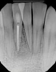 Two-year posttreatment radiograph of teeth Nos. 24 and 25 demonstrating complete resolution of the radiolucent periapical lesion around the extruded sealer material and the attainment of previously lost bone in the vertical dimension. The combination of endodontic treatment and periodontal surgery repaired the bony defect.