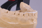 The mandibular anterior teeth were waxed to visualize the proposed changes needed to establish the new occlusal scheme.