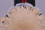 Occlusal markings on the cast indicated smooth transitions in laterotrusive movements on the articulator.