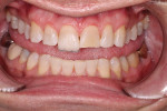 Composite was layered from the lingual aspect to the facial aspect of tooth No. 8 using a putty matrix to transfer the newly proposed wax-up contours. First, a translucent composite (Filtek™ Supreme Ultra [CT], 3M) was placed, then dentinal lobes were created with a dentin shade composite (Filtek™ Supreme Ultra [B1B], 3M). Maverick color was then added for detail in the incisal edge, followed by an enamel layer of composite (Filtek™ Supreme Ultra [B1E], 3M).