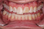 The full contour buildup of tooth No. 8 would act as a guide for the restoration of the remaining maxillary teeth to be treated.
